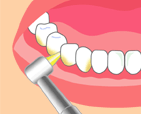 歯石取り